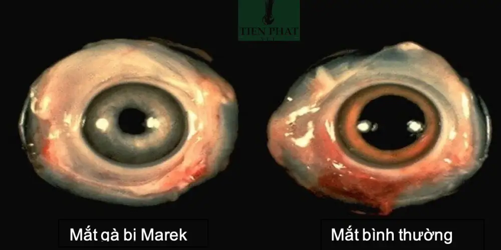 Một số trường hợp ghi nhận biến đổi ở mắt như đồng tử không đều, mất phản xạ ánh sáng, dẫn đến mù lòa.